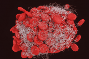 Thrombosis, Antithrombotics, and Thrombolytics